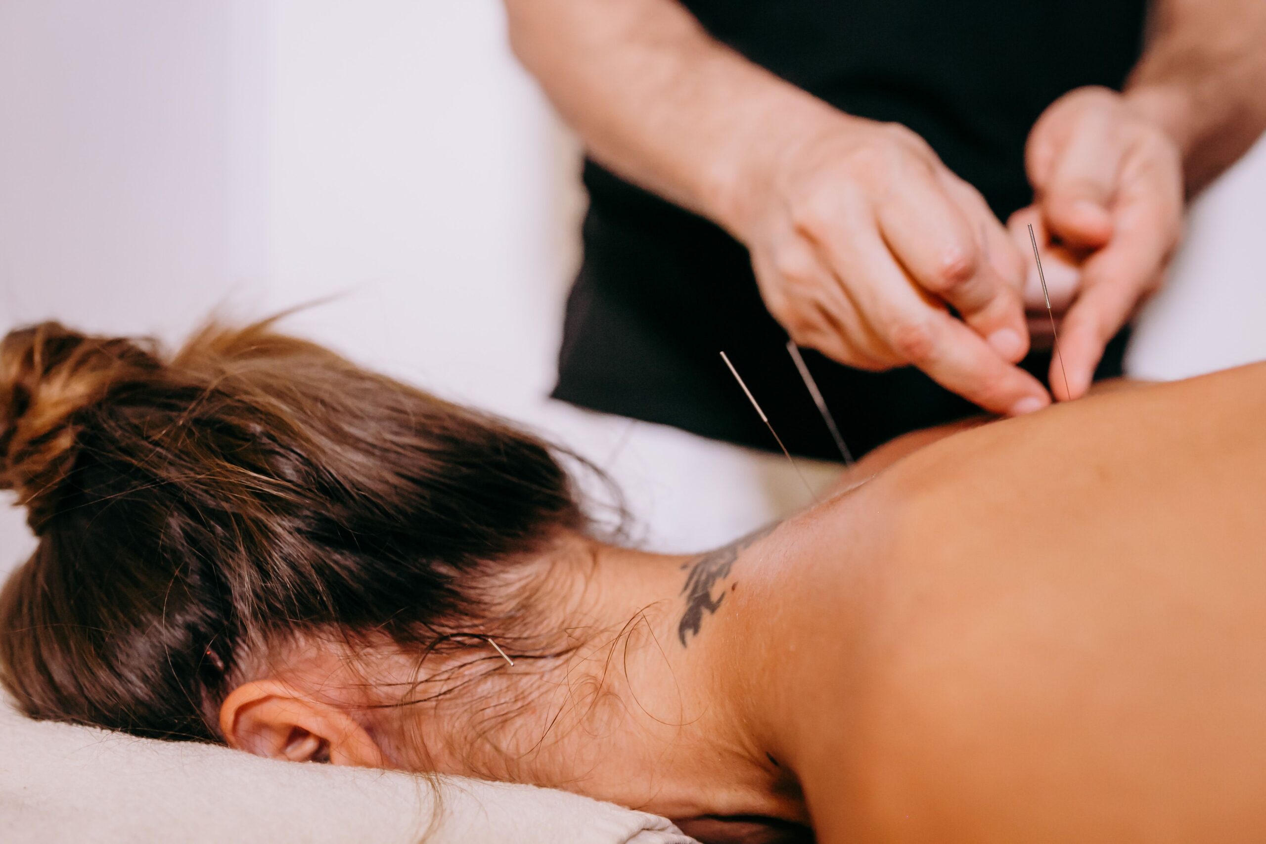 Praticien insérant des aiguilles d'acupuncture dans le dos d'un patient