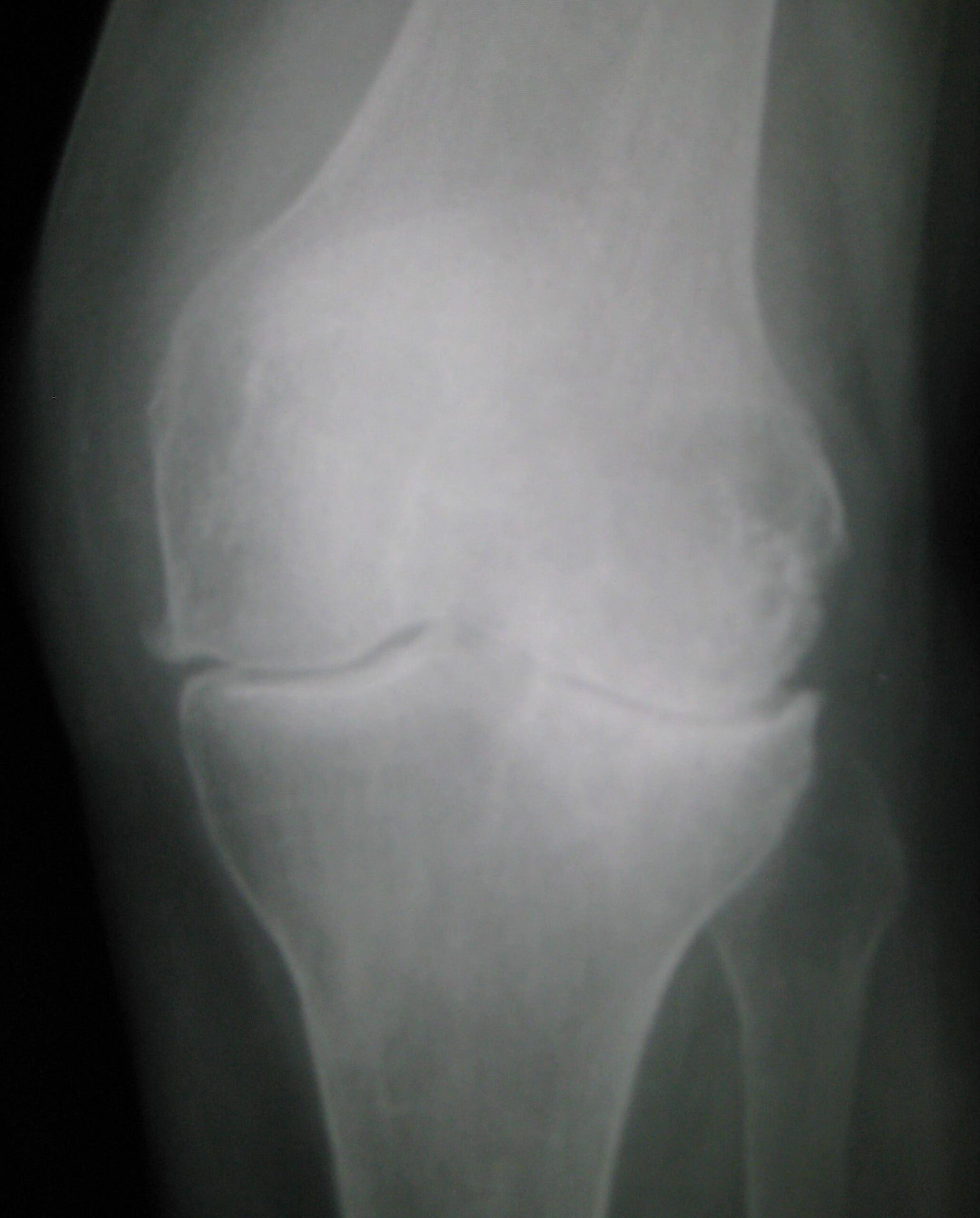Médecines douces et arthrose : soulager et garder le mouvement